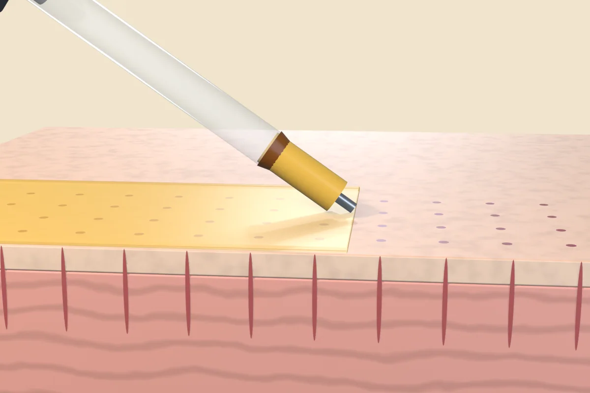 Syringe tip spreading golden platelet-rich plasma across a skin surface dotted with fine needle punctures