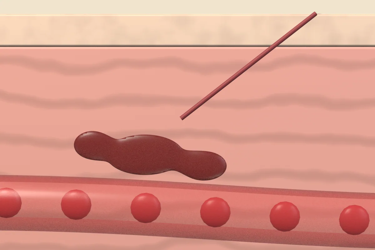 Skin cross-section with a small dark red pool of blood in the dermis beside a fine needle track, above a small blood vessel